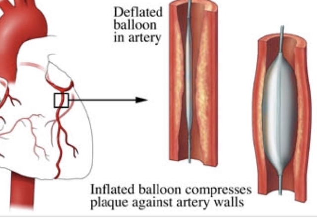 Coronary Angioplasty