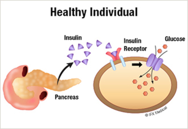 Pathology of Type II Diabetes