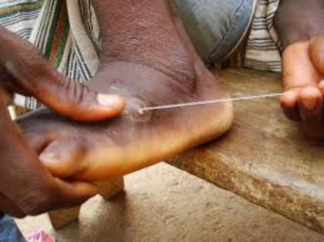 Guinea worm