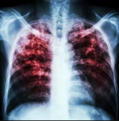 First vaccine developed for tuberculosis