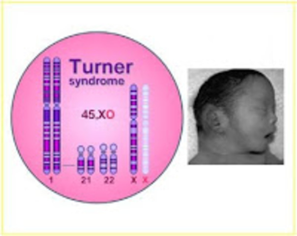 Sindrome de Turner