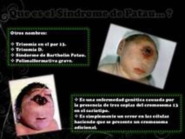 Síndrome de Patau