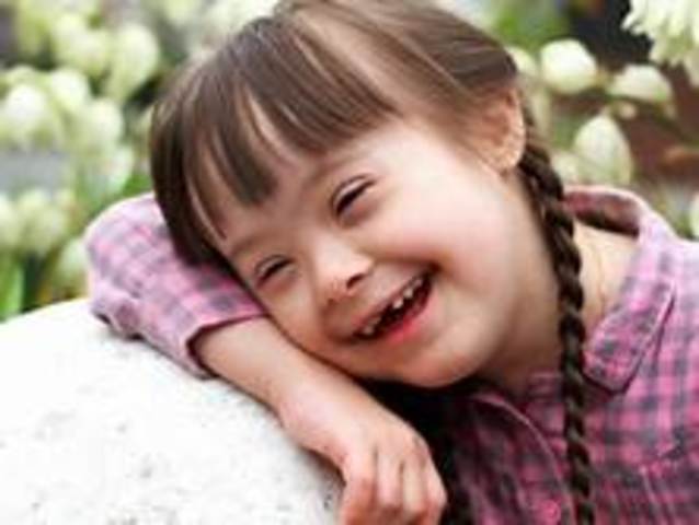 Síndrome de Down o trisomía 21