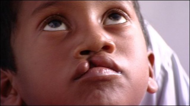 Hassan gets surgery for his cleft lip