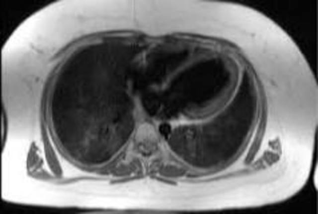 Síndrome de Alström