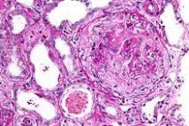 Síndrome de Goodpasture