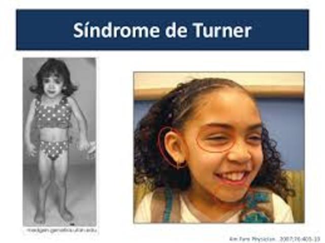 sindrome de turner