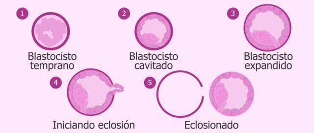 Degeneración de zona pelúcida