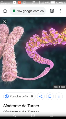 Síndrome Del Turner