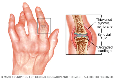Rheumatoid Arthritis