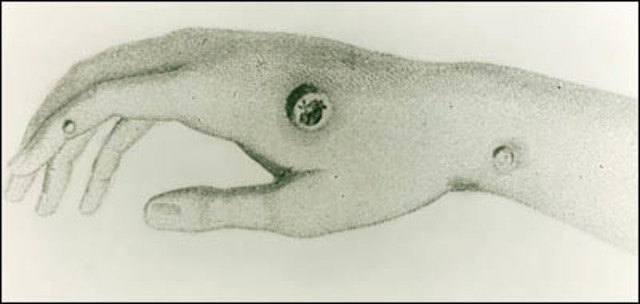 Variolation Technique