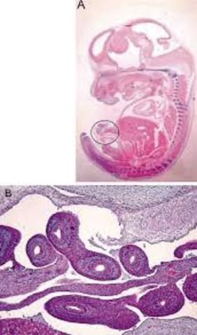 Hernia del cordón umbilical