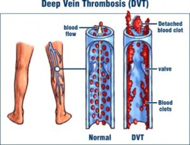 March is declared Deep-Vein Thrombosis Awareness Month