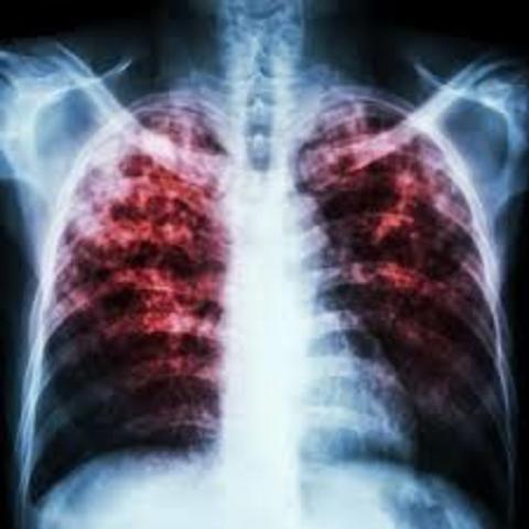 First Vaccine for Tuberculosis