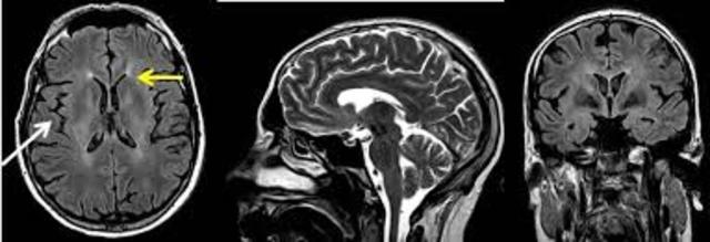 Descubrimiento de la cura para la Neurosifilis