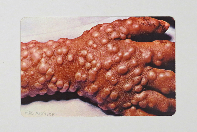 Rhazes (middle ages)