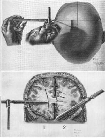 Lobectomias como tratamiento