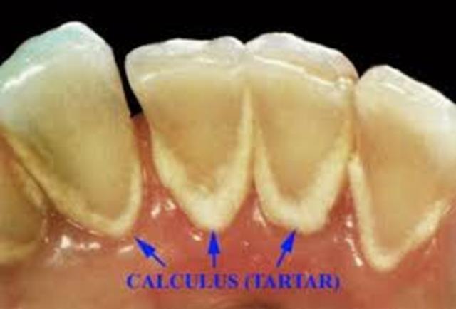 Formación de calculo dental y tipos de gingivitis