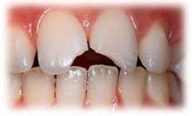 Traumatismos dentoalveolares