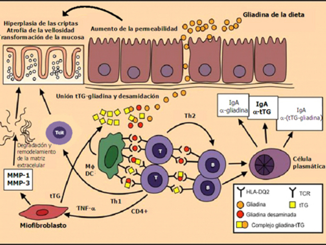 Se asocia un autoanticuerpo a la diabetes tipo 1
