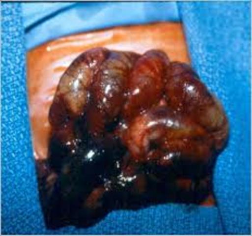 85 casos de “necrotizing enterocolitis”