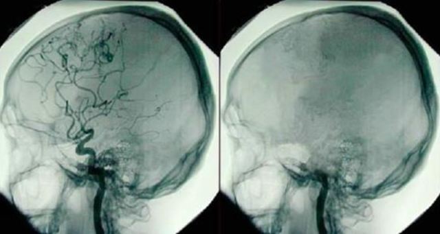 Nuevo criterio basado en la  muerte cerebral.