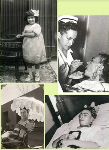 La poliomielitis de Frida