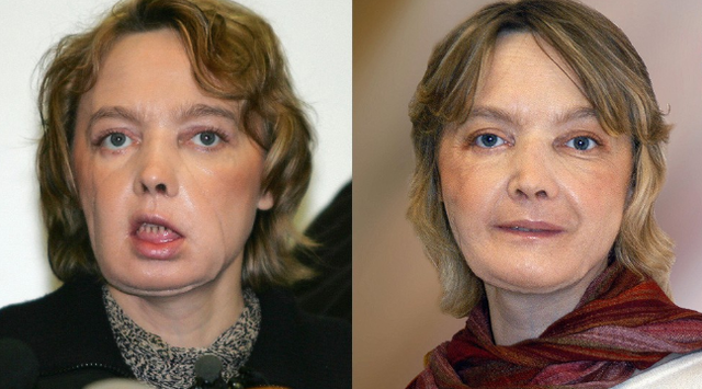 Face Transplant