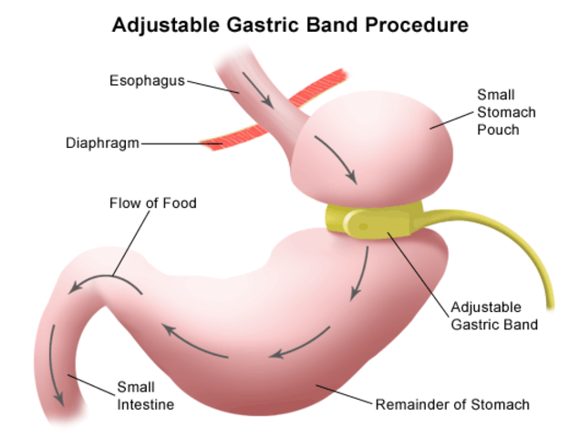 Gastric Baning Introduced