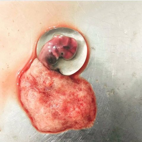 RIESGO DE ABORTO EXPONTANEO