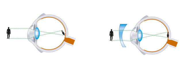 Lentes de astigmatismo