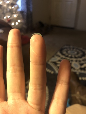 Finger Accident