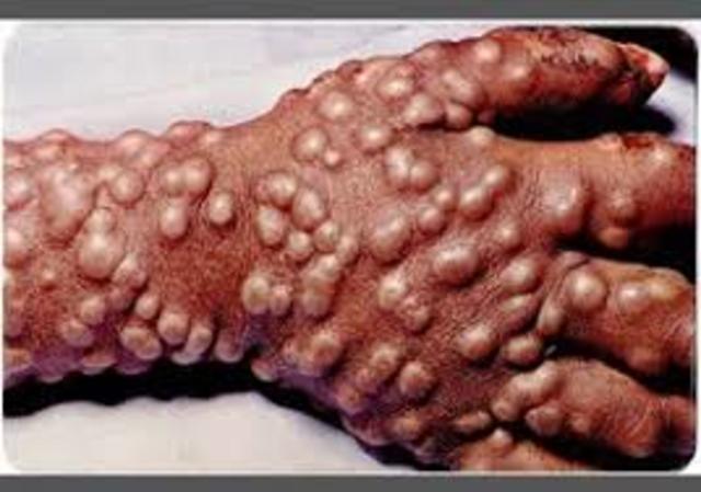 smallpox kills Native Americans