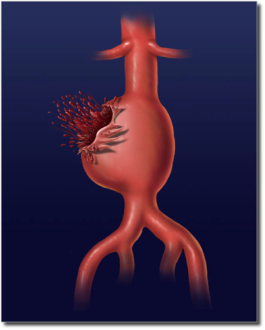 Robert's father developed an aortix aneurysm