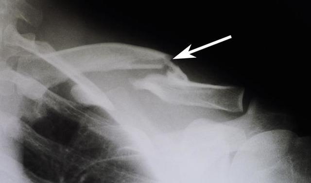 broken bone(collar bone)