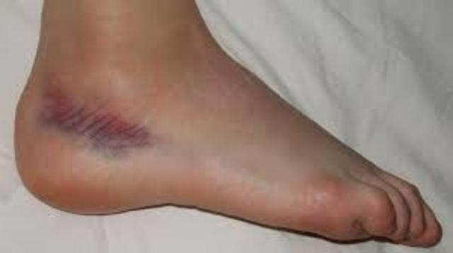 twisted ankle