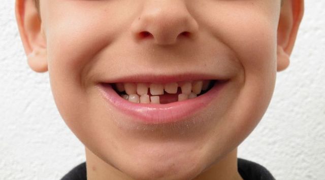 Em cau la primer dent