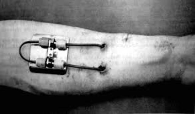 Invention of AV Shunt (Arterio-Venous Shunt) by Dr. Belding Scribner