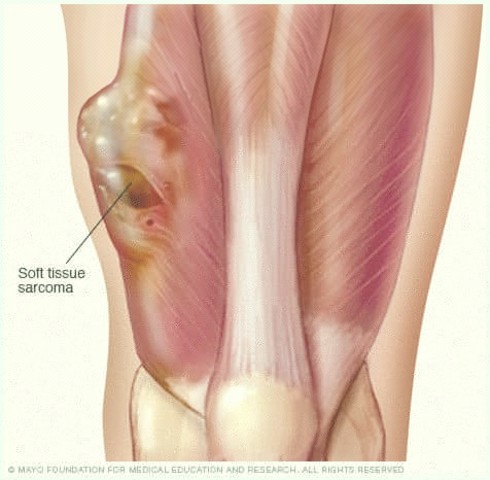 Diversos casos de sarcoma.