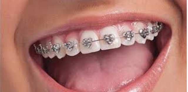 today modern time braces