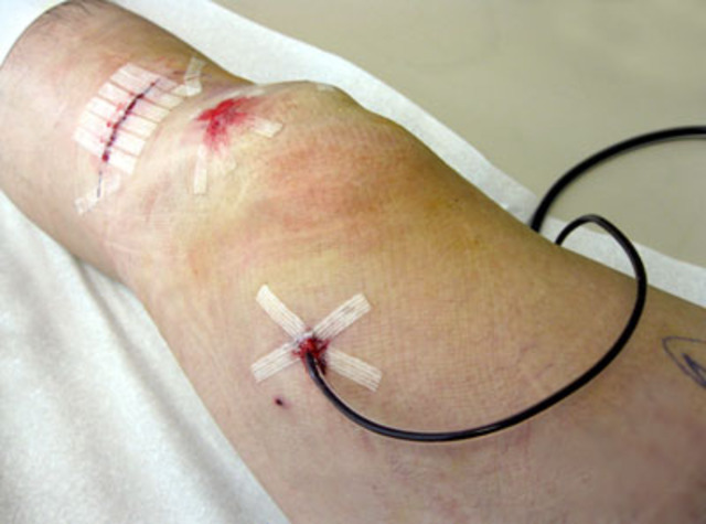 ACL Surgery....Yikes