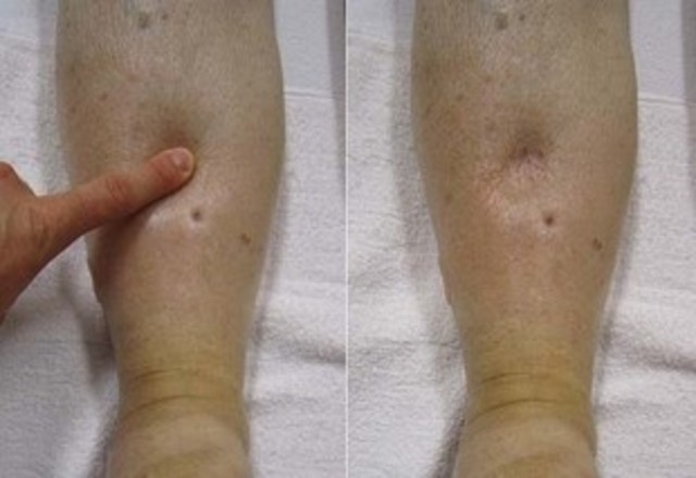 Marcha para Hidropesia