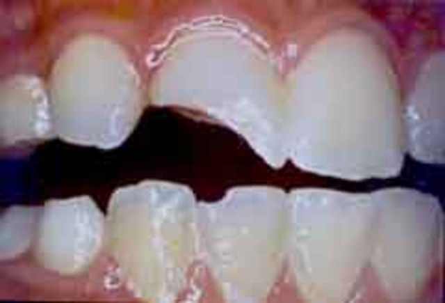 First Notable Injury