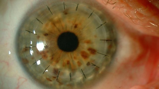 Primer trasplante exitoso