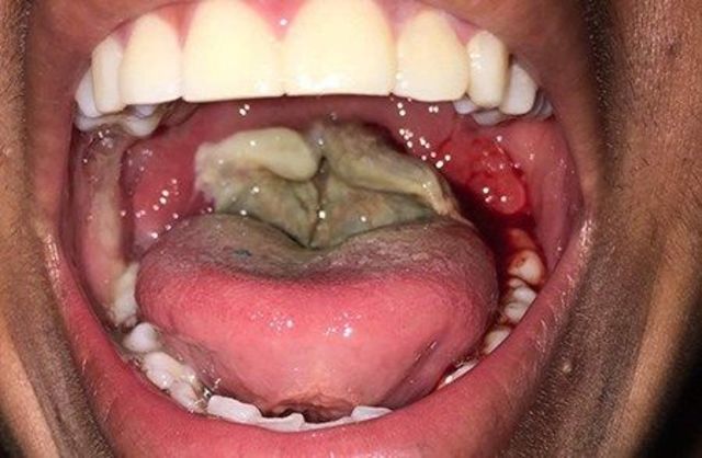 Antitoxina contra difteria