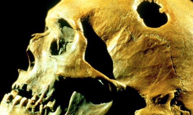 Se encuentran las primeras evidencias del uso de la trepanación como procedimiento quirúrgico