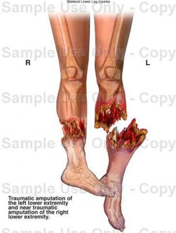 First noteable injury!