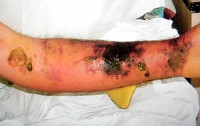 Se desarrolla la vacuna contra el carbunco