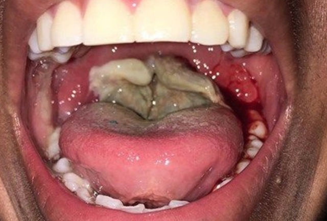 Se crea la vacuna contra la difteria