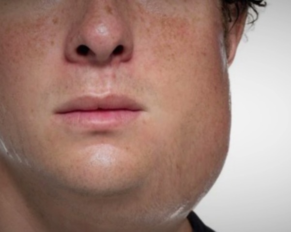 Se crea la vacuna contra la parotiditis